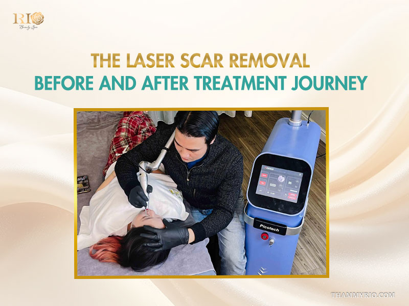Professional technician performing a laser scar removal before and after treatment session using Picotech technology on a client's face.