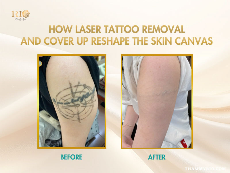 Before and after results of laser tattoo removal and cover up on upper arm at Rio Beauty Spa.