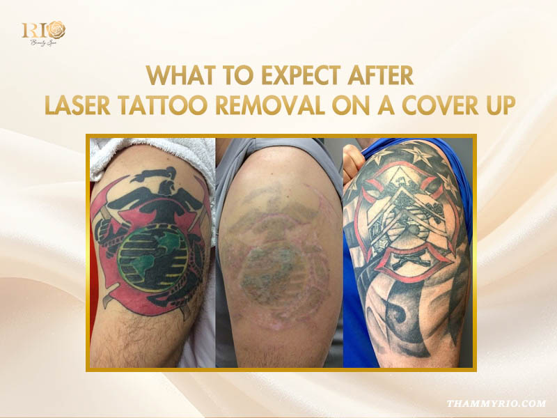 Three-stage process of laser tattoo removal and cover up for a large arm tattoo at Rio Beauty Spa.