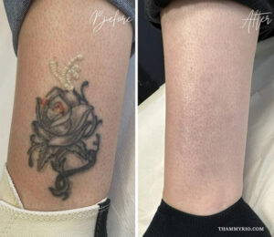 Before and after results of a professional leg tattoo removal treatment showing complete fading of a rose design.