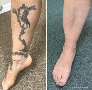 Before and after comparison of leg tattoo removal showing complete fading of a butterfly and flower vine on the ankle.