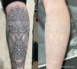 Professional leg tattoo removal results for a large owl and mandala design, showing nearly complete fading after laser treatment.