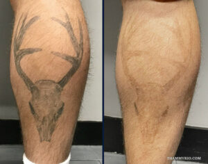 Professional leg tattoo removal results on a male calf showing the significant fading of a grey deer skull design.