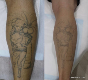 Leg tattoo removal process on a calf featuring a pin-up girl design showing significant fading after laser sessions.