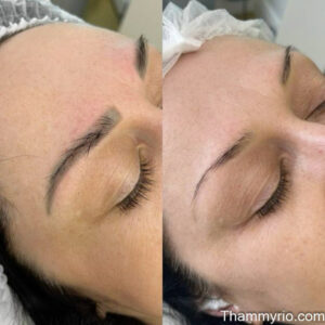 Microblading removal before and after results showing faded eyebrow pigment.