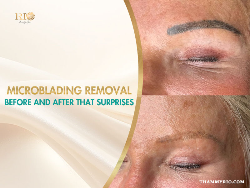 Microblading removal before and after surprising results at Rio Beauty Spa.