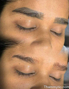 Microblading removal before and after on dark eyebrow pigment.
