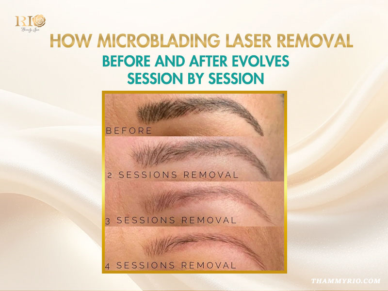 Microblading removal before and after progress through 4 laser sessions.