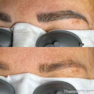Detailed microblading removal before and after results on permanent eyebrow makeup.