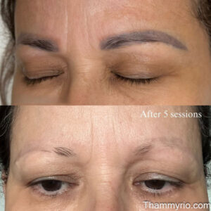 Microblading removal before and after results after 5 laser sessions.