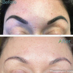 Before and after comparison of eyebrow permanent makeup removal showing complete ink clearing.