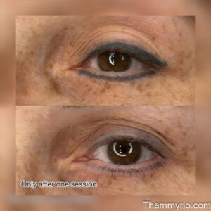 Before and after results of eyeliner permanent makeup removal only after one session.