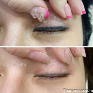 A detailed close-up showing the progression of eyeliner permanent makeup removal on a client.