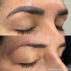 Before and after results of a permanent makeup removal treatment on eyebrows.
