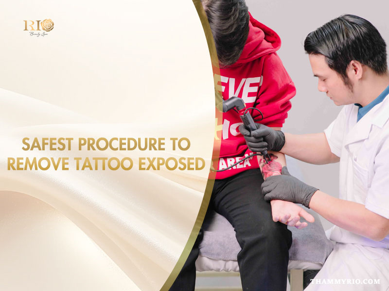 Professional technician performing a laser procedure to remove tattoo on a client's forearm at Rio Beauty Spa.