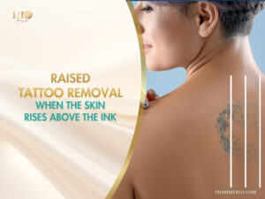 A woman showing a colorful back tattoo with textured skin for raised tattoo removal treatment.