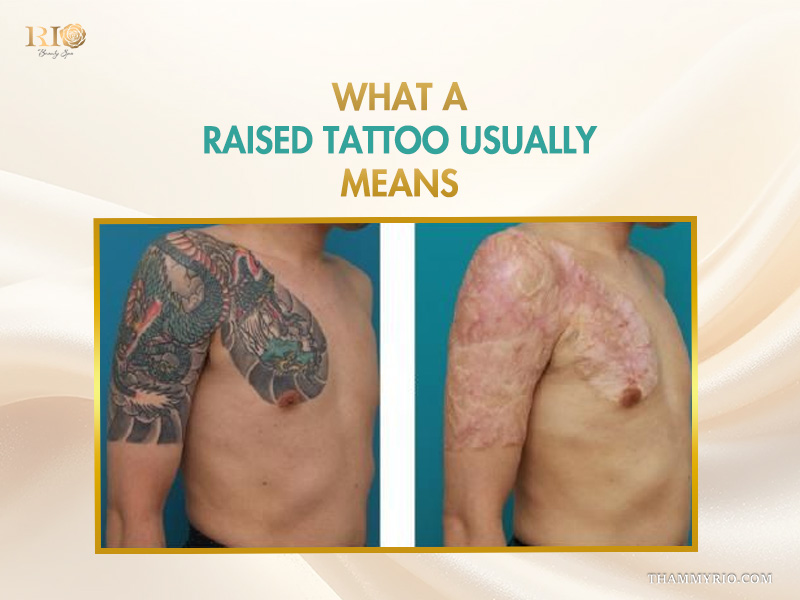 Before and after comparison of a large dragon tattoo showing scarring and raised tattoo removal results.