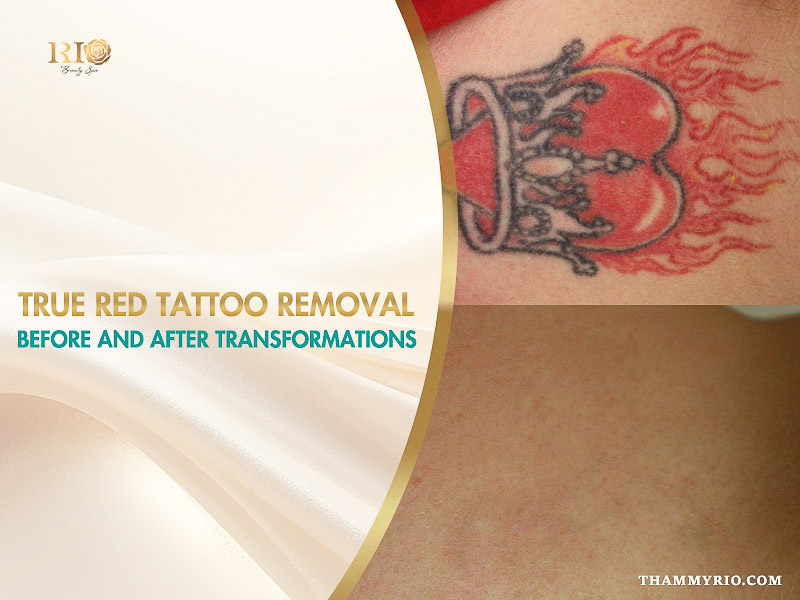 A close-up comparison of red tattoo removal before and after treatment, showing successful ink clearance on the skin.