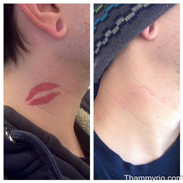 Professional red tattoo removal before and after showing a complete fade on the neck area.