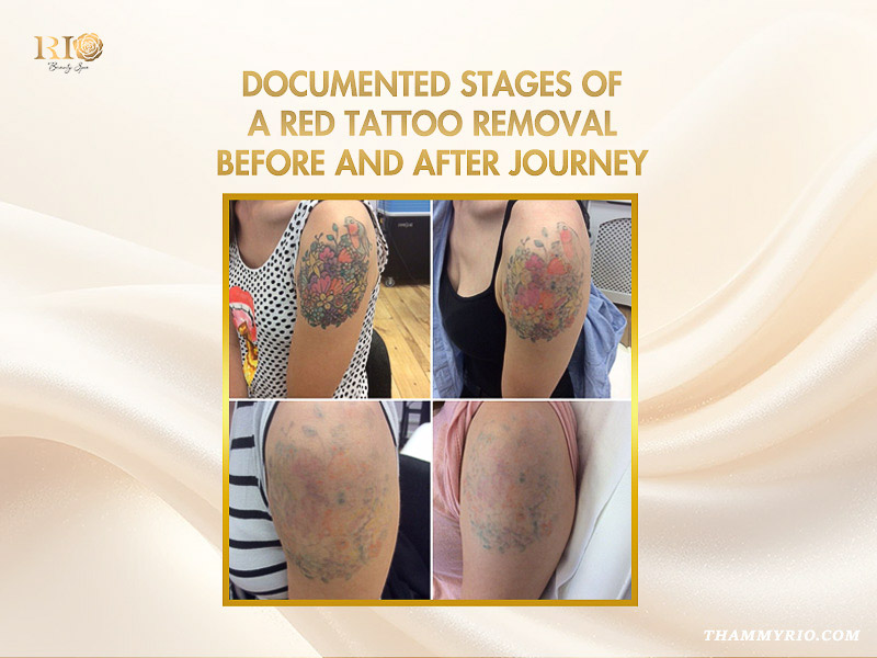 Documented stages of red tattoo removal before and after journey at Rio Beauty Spa.