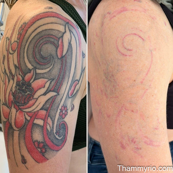 Professional red tattoo removal before and after showing significant fading on arm ink.