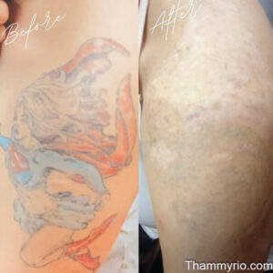 Dramatic red tattoo removal before and after showing effective pigment fading on skin.