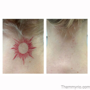 Professional red tattoo removal before and after showing clear skin transformation at Rio.