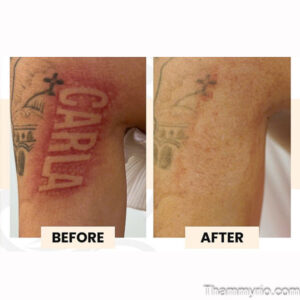 A comparison image showcasing red tattoo removal before and after on an arm with a 'CARLA' name tattoo at Rio.