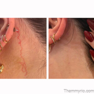 Delicate red tattoo removal before and after showing complete clearance on the neck area.