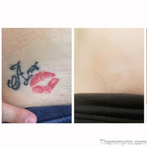 Successful red tattoo removal before and after showing clean skin on the hip area.