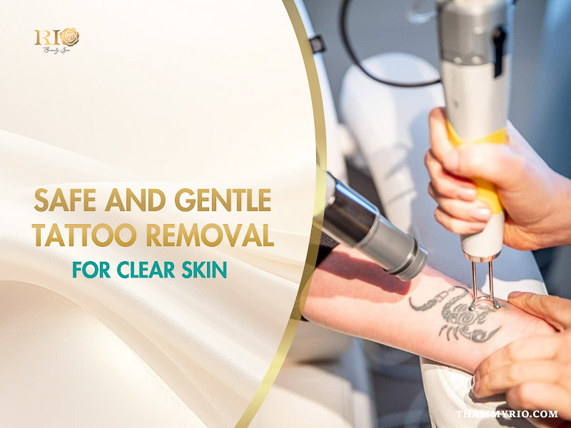 Safe and gentle tattoo removal procedure using modern laser technology for clear skin.