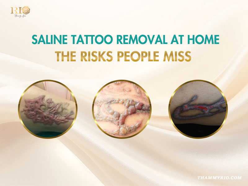 Severe skin scarring and infections caused by failed salt tattoo removal at home.