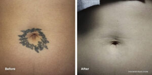 Before and after results of stomach tattoo removal around the navel area.