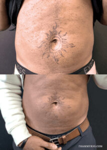 Progress of stomach tattoo removal on a sun-shaped design around the navel.