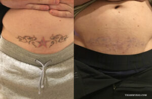 Laser stomach tattoo removal before and after results on a tribal star design.