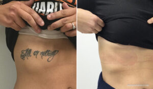 Before and after comparison of stomach tattoo removal for a script quote saying all or nothing.