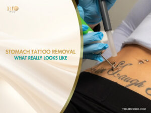 Professional stomach tattoo removal procedure using laser technology on a script tattoo.