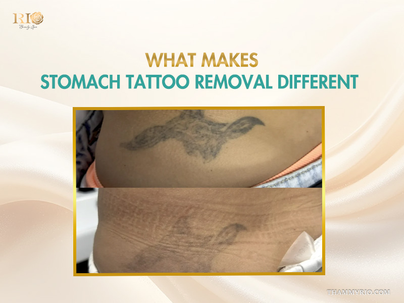Comparison of stomach tattoo removal showing successful results on a large black tribal tattoo.