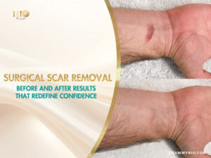 Surgical scar removal before and after on a wrist at Rio Beauty Spa.
