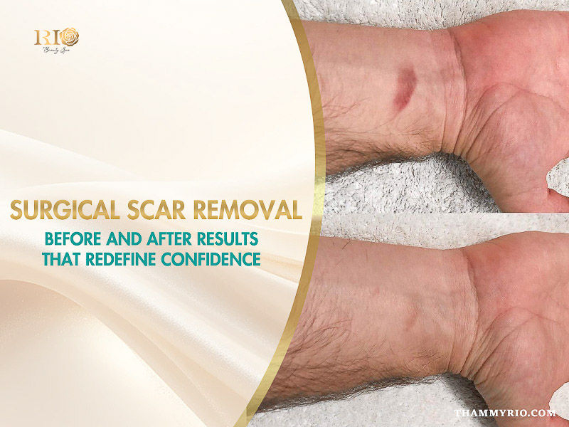 Surgical scar removal before and after on a wrist at Rio Beauty Spa.