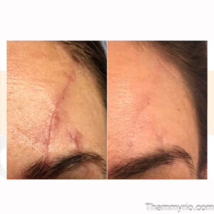 Surgical scar removal before and after for a forehead scar at Rio.
