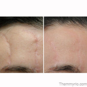 Surgical scar removal before and after for forehead scars at Rio.