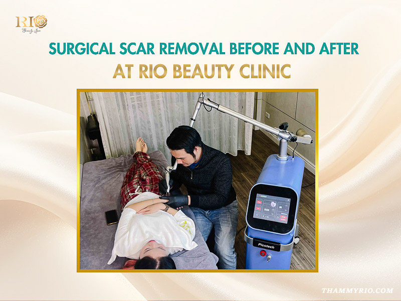 Laser surgical scar removal before and after treatment at Rio Beauty Clinic