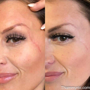 Surgical scar removal before and after results on face at Rio
