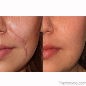 Surgical scar removal before and after treatment on a woman's face