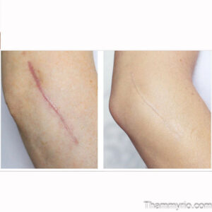 Surgical scar removal before and after results on an elbow, showing significant fading.