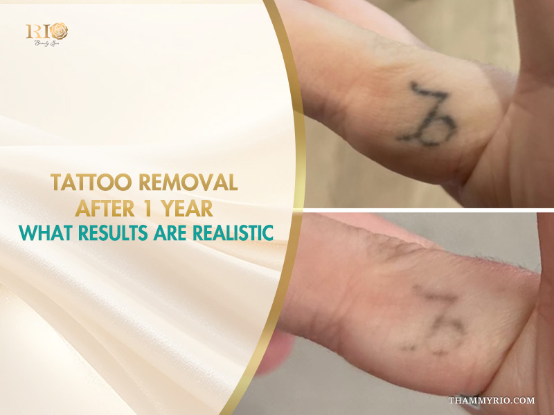 Comparison of finger tattoo removal after 1 year showing significant fading.