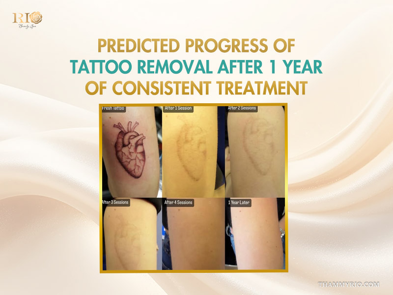 Progression of heart tattoo removal after 1 year through multiple laser sessions.