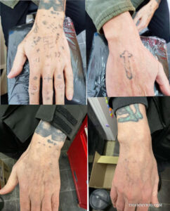 Before and after progress of hand tattoo removal for military enlistment showing the fading of various symbols.
