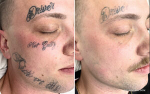 Before and after laser tattoo removal for military enlistment featuring face tattoos.
